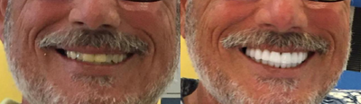 Dental Crown before and after photo