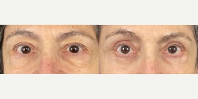 Eyelid Surgery before and after photo