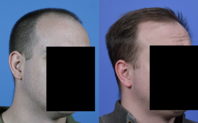 FUE Hair Transplant before and after photo