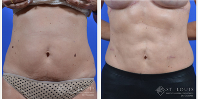 Liposuction before and after photo