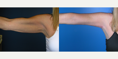 Arm Lift before and after photo
