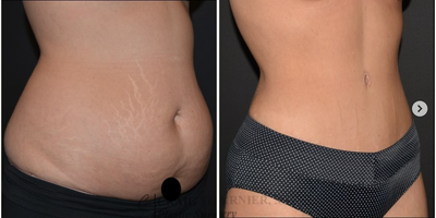 Tummy Tuck before and after photo