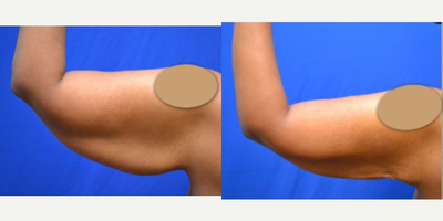 Arm Lift before and after photo