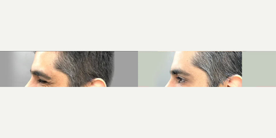 Botox before and after photo