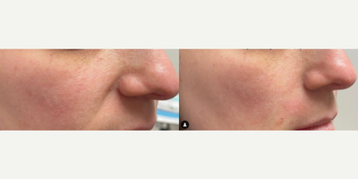 Dermal Fillers before and after photo