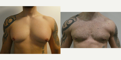 Gynecomastia Surgery before and after photo