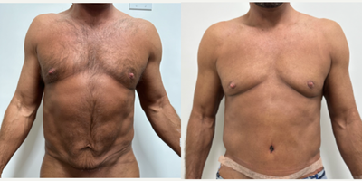 Lipo 360 before and after photo