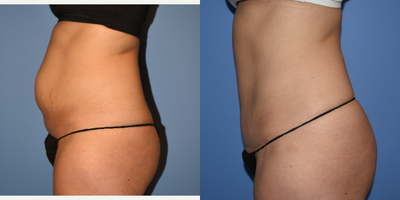 Mini Tummy Tuck before and after photo