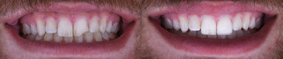 Porcelain Veneers before and after photo