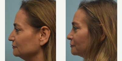 Rhinoplasty before and after photo
