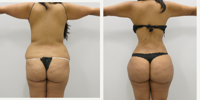 Smart Lipo before and after photo