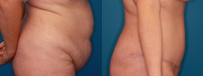 Tummy Tuck before and after photo