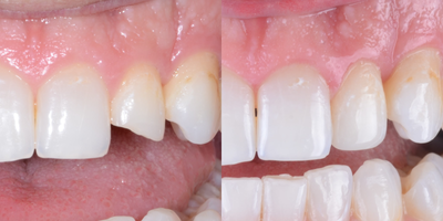 Dental Bonding before and after photo