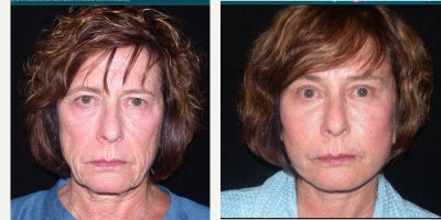 Facelift before and after photo