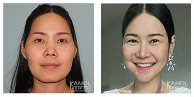 Facial Reconstructive Surgery before and after photo