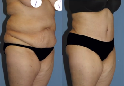 Liposuction before and after photo