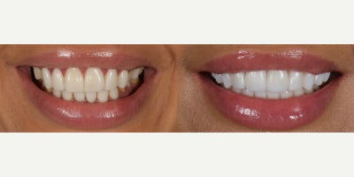 Smile Makeover before and after photo