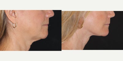Chin Implant before and after photo