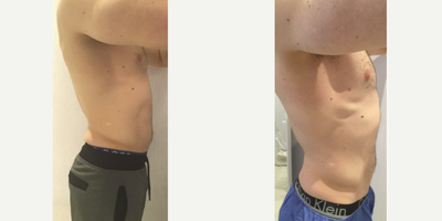 CoolSculpting before and after photo