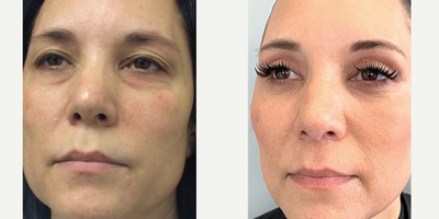Eyelid Surgery before and after photo