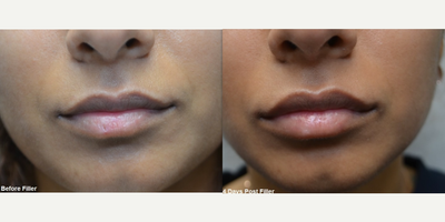 Lip Fillers before and after photo