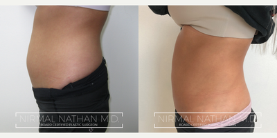Liposuction before and after photo