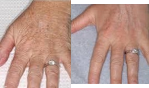 Radiesse before and after photo