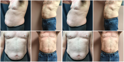 Vaser Liposuction before and after photo