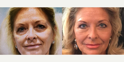 Dermal Fillers before and after photo