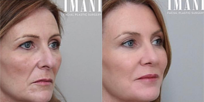 Dermal Fillers before and after photo
