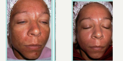 Laser Resurfacing before and after photo