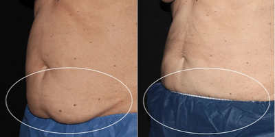 CoolSculpting before and after photo