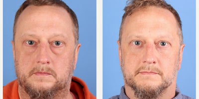 Eyelid Surgery before and after photo