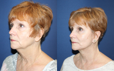 Facelift before and after photo