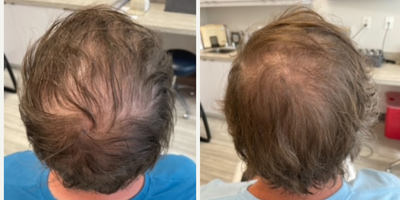 PRP for Hair Loss before and after photo