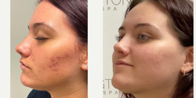 AviClear before and after photo