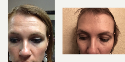 Botox before and after photo