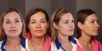 Eyelid Surgery before and after photo