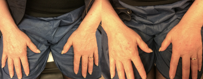 Hand Rejuvenation before and after photo