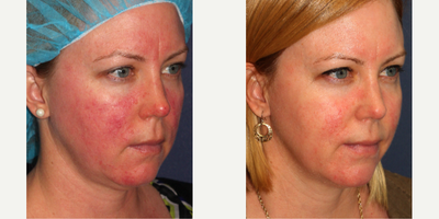 IPL before and after photo