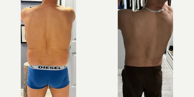 Liposculpture before and after photo