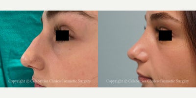 Rhinoplasty before and after photo