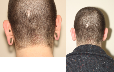 Earlobe Repair before and after photo
