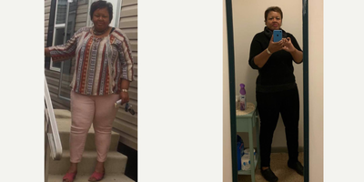 Gastric Bypass before and after photo