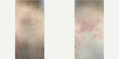 Laser Genesis before and after photo
