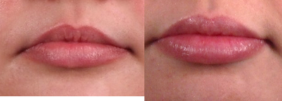 Lip Fillers before and after photo