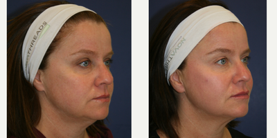 Nonsurgical Facelift before and after photo