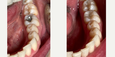 Tooth Repair before and after photo