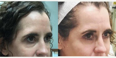 Bellafill before and after photo