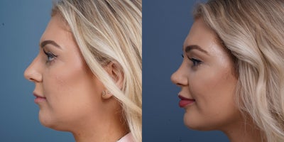 Chin Implant before and after photo
